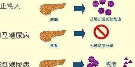 胰岛素抵抗：二甲双胍治疗及综合应对策略